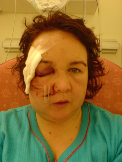 Первая травма оставила Клэр без правого глаза